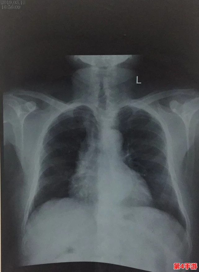 胸片全体曝光:揭示医疗影像背后的隐秘故事与患者健康的真实状况,值得每个人关注和思考 胸片全体曝光:揭示医疗影像背后的隐秘故事与患者健康的真实状况,值得每个人关注和思考
